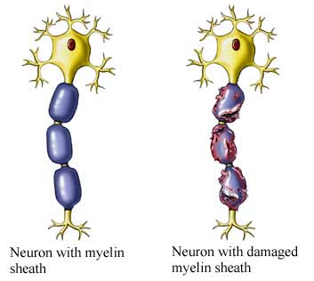 HEALTHY VS DAMAGED NERVES