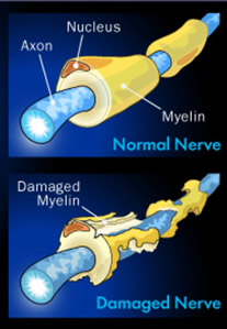 damaged nerve causes