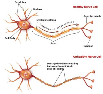 healthy v unhealthy nerves