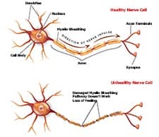 Neuropathy Information - Healthy vs Unhealthy Nerves